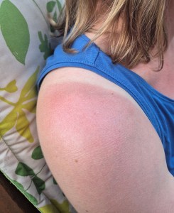 Scottish sunburn is a rare, but real, thing